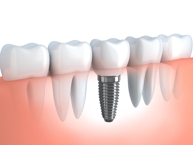 Dental Implants  Chattanooga, TN 